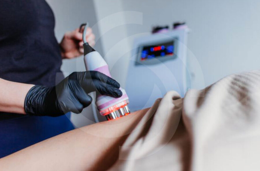 Cavitation and Radiofrequency